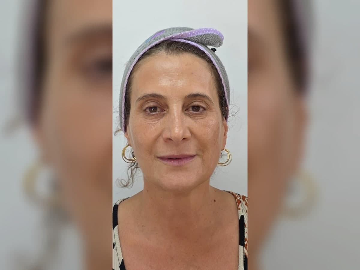 Registro posterior de tratamiento facial personalizado.