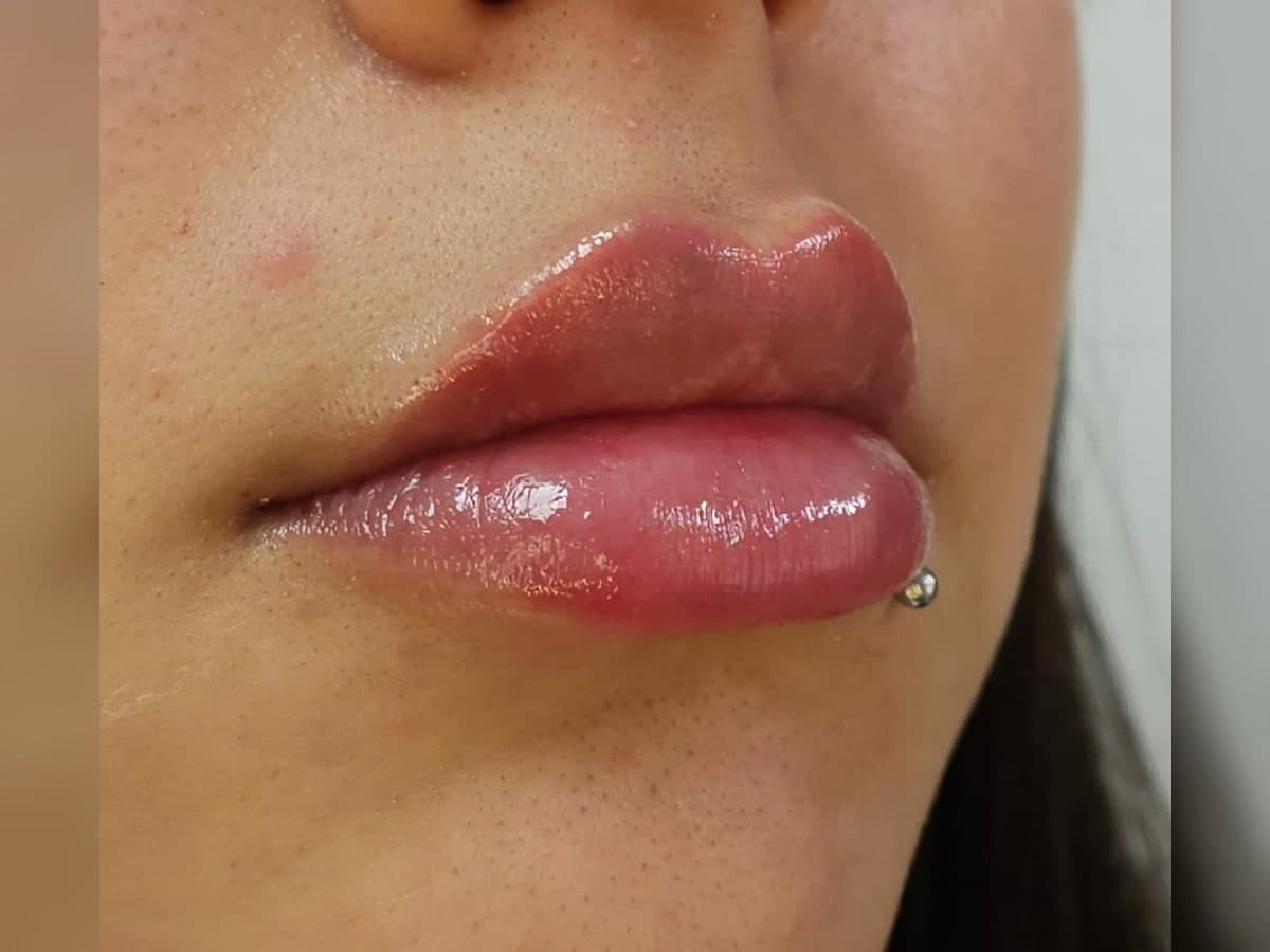 Registro posterior de tratamiento facial en labios.