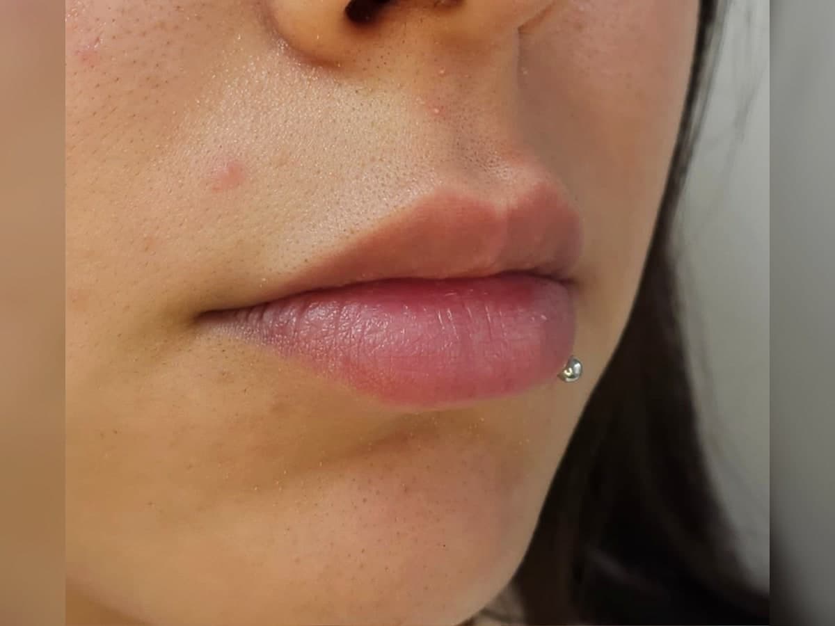 Registro previo de tratamiento facial en labios.