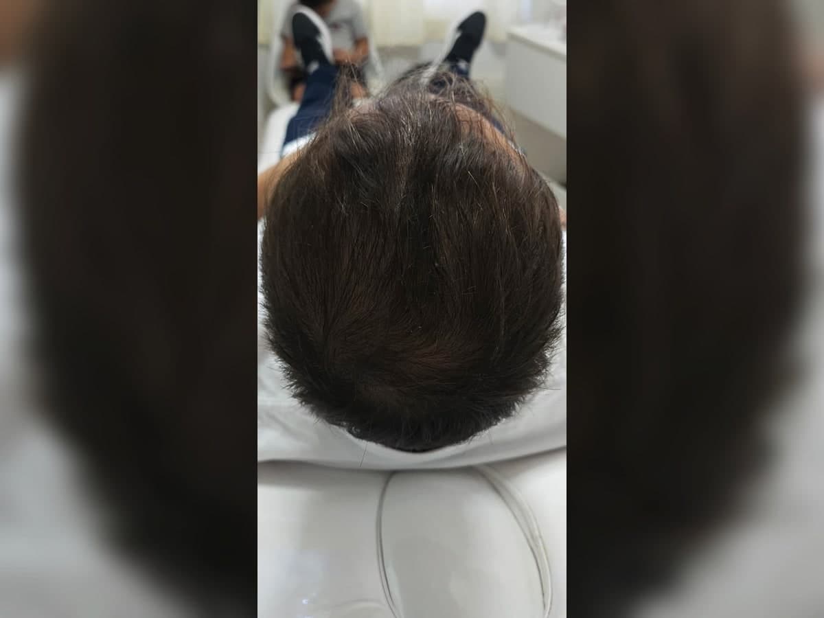 Registro posterior de tratamiento capilar.